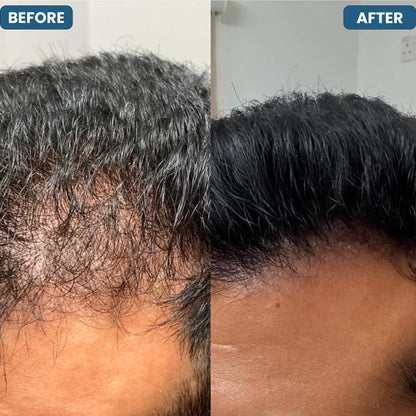 HAIR GROWTH SERUM ROLLER
